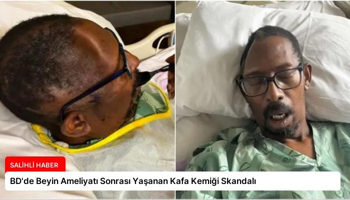 BD’de Beyin Ameliyatı Sonrası Yaşanan Kafa Kemiği Skandalı